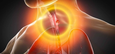 الارتجاع الحمضي المزمن يزيد من خطر الإصابة بسرطان المريء؟!