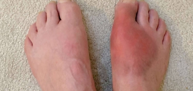 دراسة: مواد غذائية تخفّض خطر تطور النقرس وأخرى تزيده !؟