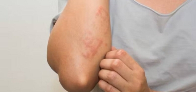 مُركّب طبيعي يكافح أمراضاً جلدية