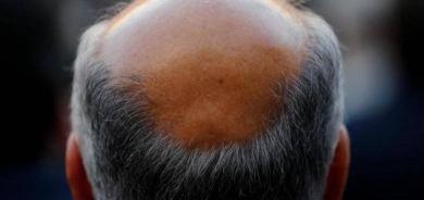 كيف تعرف إذا كنت ستصاب بالصلع؟ ومتى؟