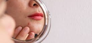 ما أضرار فقع البثور الجلدية؟