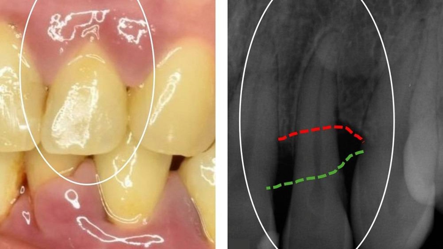 ما أسباب الالتهابات الحادة للثة؟