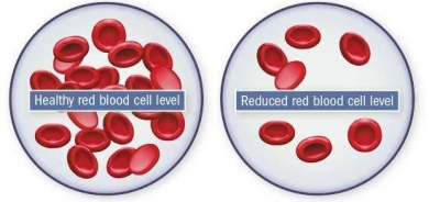 انتبه إلى المؤشرات الدقيقة لفقر الدم