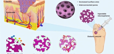 علاج مبتكر لجروح مرضى السكري
