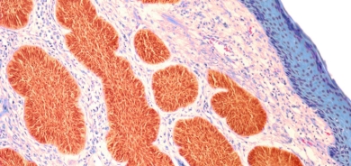 «تقنيات جينومية» لفهم أعمق لسرطان الجلد العدواني