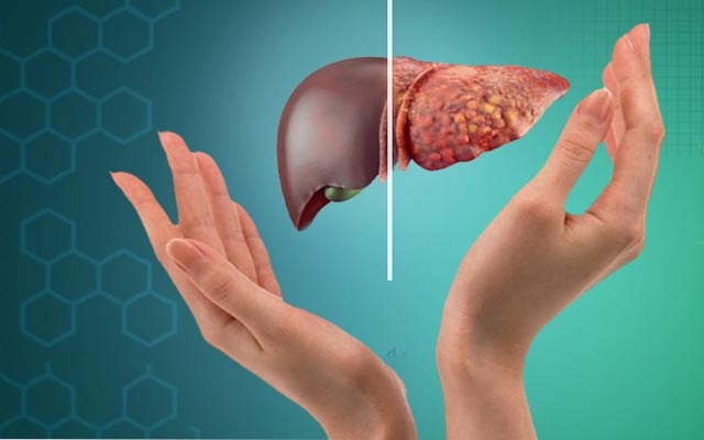 زیادبوونی چەوریی جگەر نەخۆشیی شەكرە پەیدا دەكات!