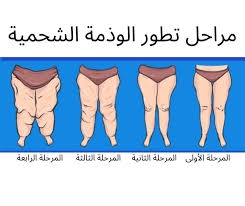 أعراضها تشبه السمنة... ما هي الوذمة الشحمية التي تصيب النساء؟
