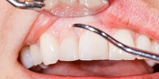 أمراض اللثة وفقدان الأسنان يؤديان إلى التدهور المعرفي