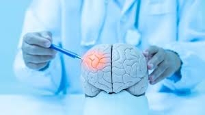 ثالث مسبب للوفاة... طرق تقلل خطر الإصابة بالسكتة الدماغية