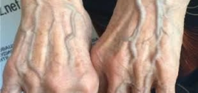 استشارات: انتفاخ أوردة ظاهر اليد