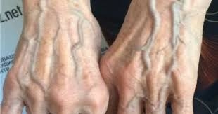 استشارات: انتفاخ أوردة ظاهر اليد