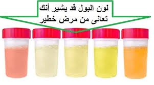 وردي أو أزرق أو عكر... ماذا يعكس لون البول عن حالتك الصحية؟