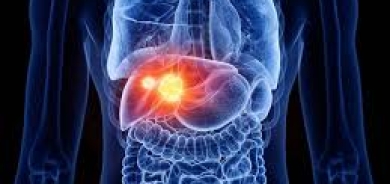 علاج جديد يقضي على سرطان الكبد