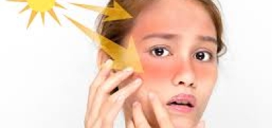 وصفات طبيعية جديدة للتخلص من حروق الشمس في الصيف