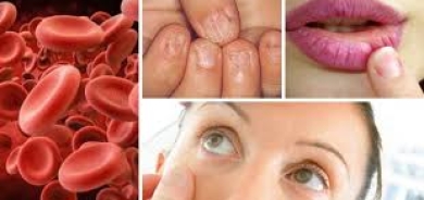 فقر الدم بسبب نقص الحديد... الأسباب والأعراض وطرق الوقاية وكيف يؤثر على الأعصاب؟