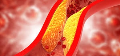 ما هو الكولسترول «الضار»؟ وكيف نخفضه؟