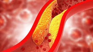 ما هو الكولسترول «الضار»؟ وكيف نخفضه؟