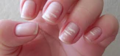 «أظافر قشر البيض»... ما هي؟ وما أبرز أسبابها؟