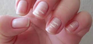 «أظافر قشر البيض»... ما هي؟ وما أبرز أسبابها؟