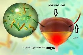 ما أسباب التهابات المسالك البولية؟