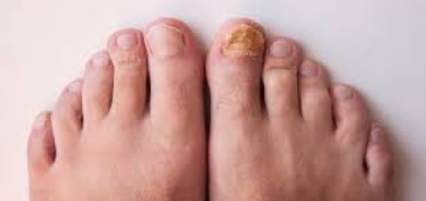 أظافر قدميك قد تكشف عن إصابتك بسرطان الرئة