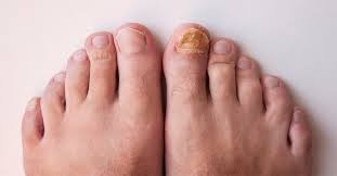 أظافر قدميك قد تكشف عن إصابتك بسرطان الرئة