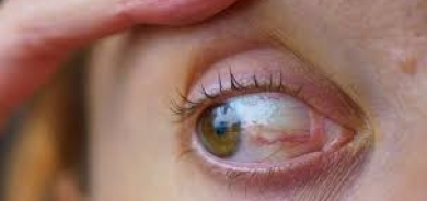 تدل على أمراض كامنة... 5 علامات في عينيك لا تتجاهلها