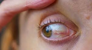 تدل على أمراض كامنة... 5 علامات في عينيك لا تتجاهلها