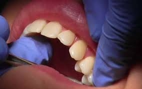 سرعة فقدان الأسنان قد تنذر بخطر الوفاة