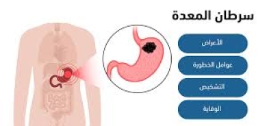 ما أبرز أعراض سرطان المعدة؟
