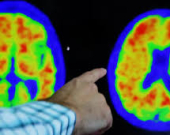 السكتة الدماغية... ما هي وما الأعراض التي يجب الانتباه إليها؟