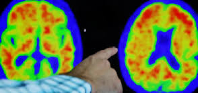 السكتة الدماغية... ما هي وما الأعراض التي يجب الانتباه إليها؟