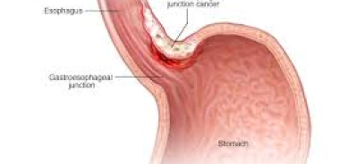 ما علاقة انتفاخ المعدة بالسرطان؟