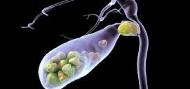 حصى المرارة... كيف تتكون وما طرق تشخيصها؟