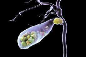 حصى المرارة... كيف تتكون وما طرق تشخيصها؟
