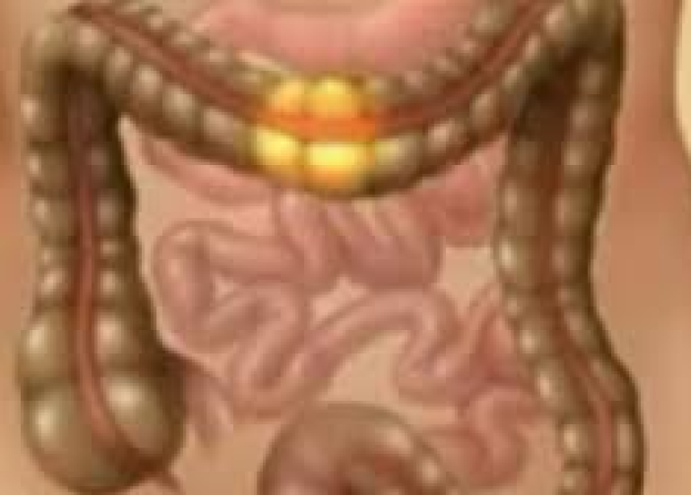 القولون العصبي ليس واحداً... تعرف على أنواعه الثلاثة