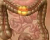 القولون العصبي ليس واحداً... تعرف على أنواعه الثلاثة