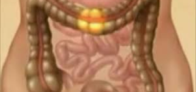 القولون العصبي ليس واحداً... تعرف على أنواعه الثلاثة