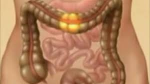 القولون العصبي ليس واحداً... تعرف على أنواعه الثلاثة