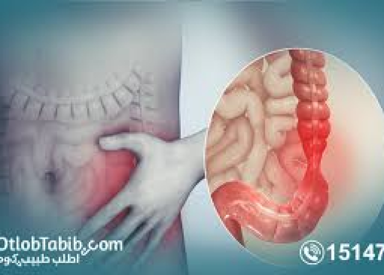 ما الذي يحدث لأمعائك أثناء نوبة القولون العصبي وكم تدوم عادةً؟