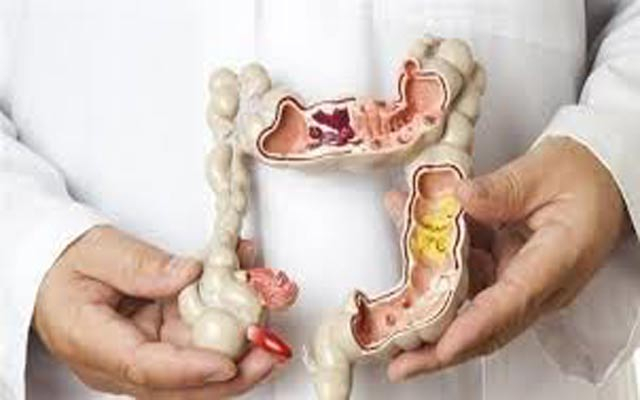 خراپترین  خۆراكەكان بۆ گرژبوونی كۆلۆن