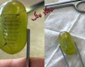 نەشتەرگەری و دوورینەوەی میوەكان