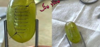 نەشتەرگەری و دوورینەوەی میوەكان