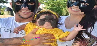 پەڵە و نەخشی ڕەش لە ڕوخساری كچێكدا