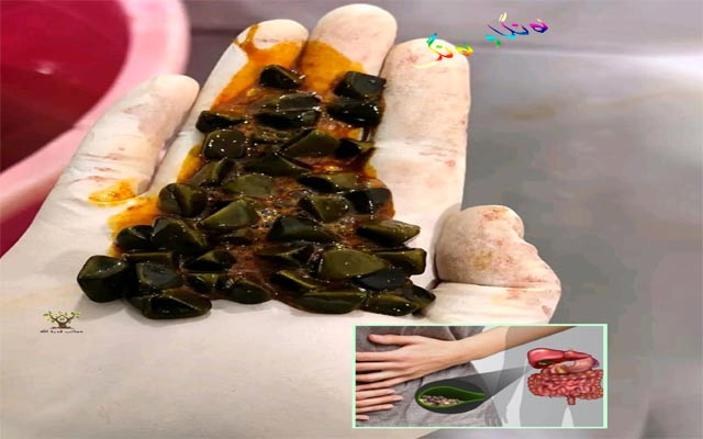 دیمەنە سەیرەكان،  ئەمە دیمەنی بەردی زراوە لە ناو لەشی مرۆڤدا
