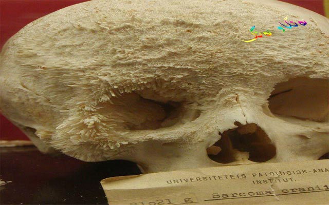 بۆ زانیاریت، شێرپەنجەی ئێسك