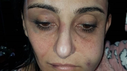 صور مؤلمة لضحية جديدة من ضحايا العنف ضد المرأة