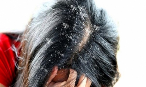 اليك هذا العلاج الفعّال للقضاء على قشرة الشعر