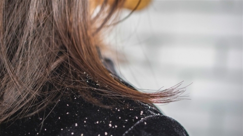 لمن يعاني من القشرة في فروة الرأس... إليك الحلّ النهائي!