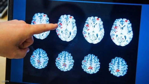 ألزهايمر.. 10 أعراض قد تعني 